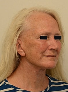 Facelift Before & After