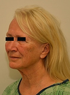 Facelift Before & After