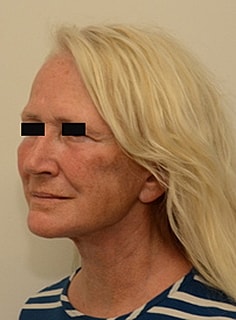 Facelift Before & After
