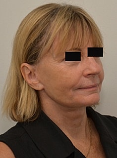 Facelift Before & After