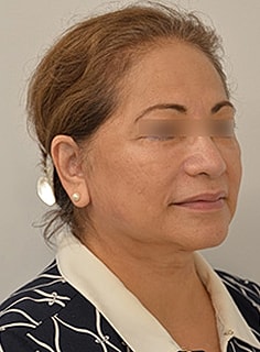 Facelift Before & After