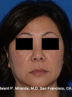 Facelift Before & After