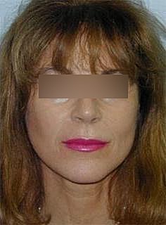 Facelift Before & After