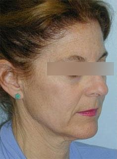 Facelift Before & After
