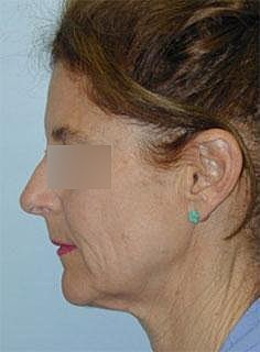 Facelift Before & After