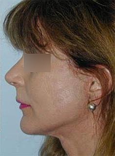 Facelift Before & After