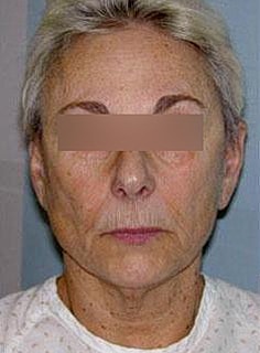 Facelift Before & After