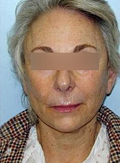 Facelift Before & After