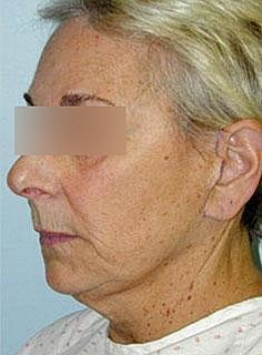 Facelift Before & After
