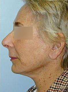 Facelift Before & After