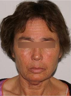 Facelift Before & After
