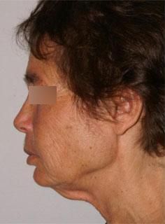 Facelift Before & After
