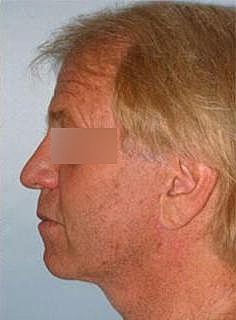 Facelift Before & After