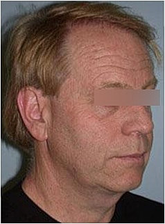 Facelift Before & After