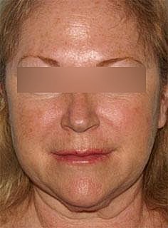 Facelift Before & After