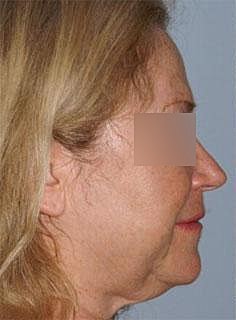 Facelift Before & After
