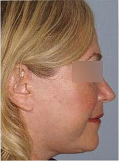 Facelift Before & After