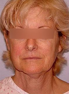 Facelift Before & After