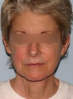 Facelift Before & After