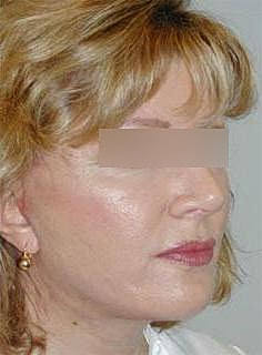 Facelift Before & After