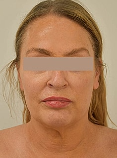 Facelift Before & After