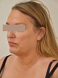 Facelift Before & After