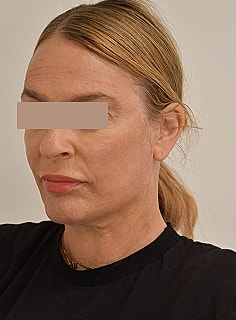 Facelift Before & After