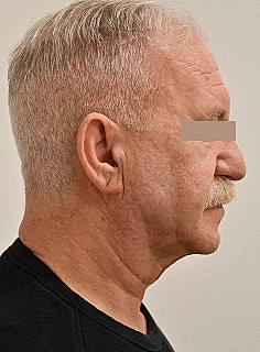 Facelift Before & After