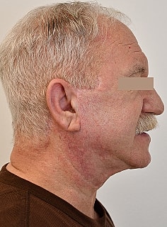 Facelift Before & After