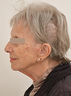 Facelift Before & After