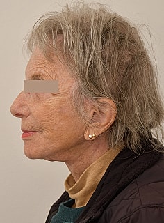 Facelift Before & After