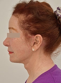 Facelift Before & After