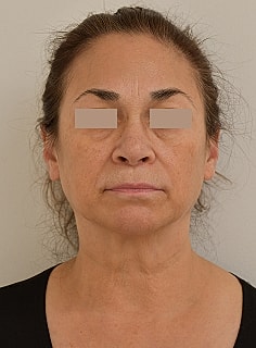 Facelift Before & After