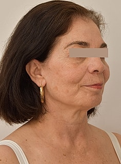 Facelift Before & After