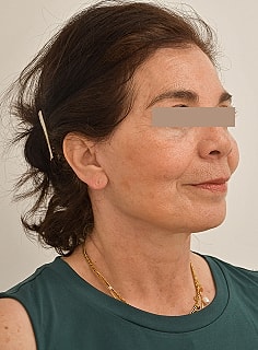 Facelift Before & After