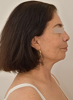 Facelift Before & After