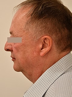 Facelift Before & After