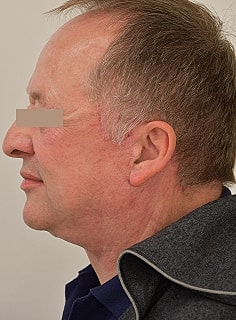 Facelift Before & After