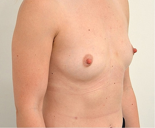 Breast Augmentation Before & After