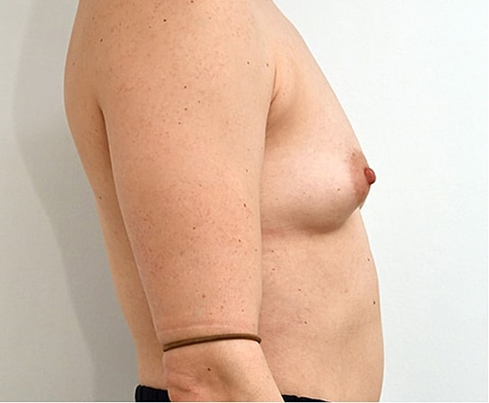 Breast Augmentation Before & After