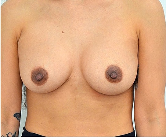 Breast Augmentation Before & After