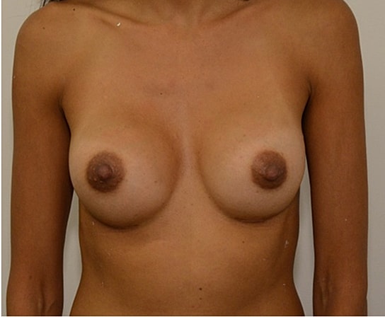 Breast Augmentation Before & After