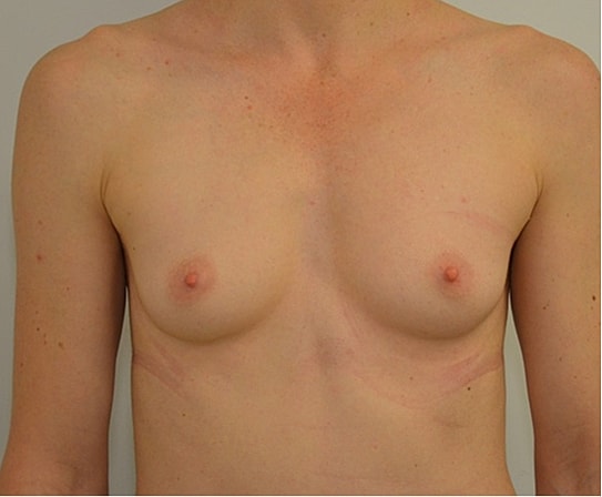 Breast Augmentation Before & After