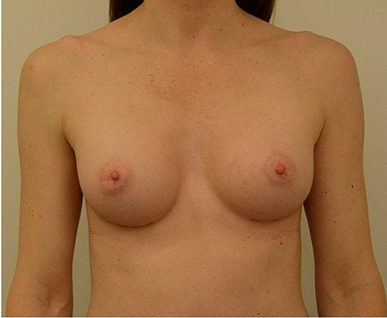 Breast Augmentation Before & After