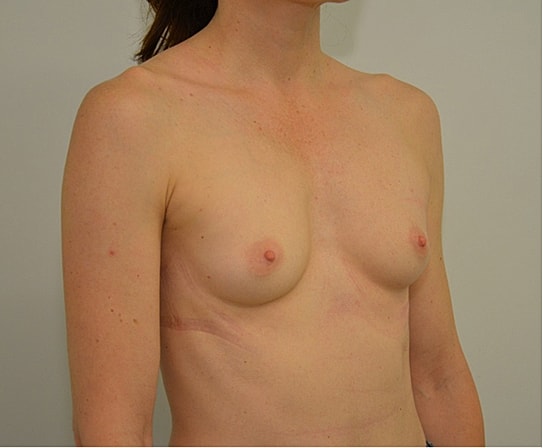 Breast Augmentation Before & After