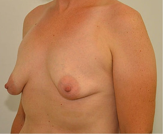 Breast Augmentation Before & After