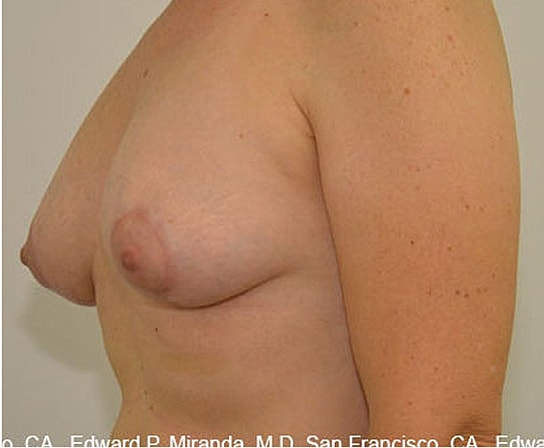 Breast Augmentation Before & After