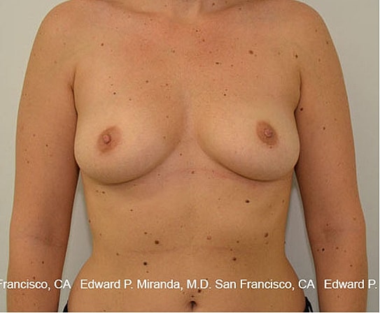 Breast Augmentation Before & After