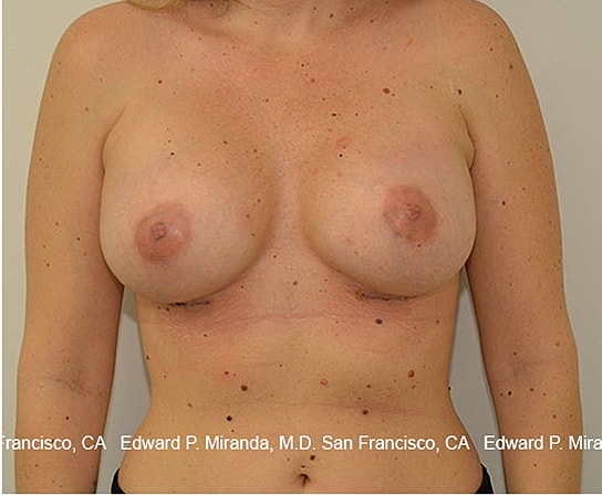 Breast Augmentation Before & After
