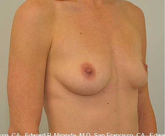 Breast Augmentation Before & After